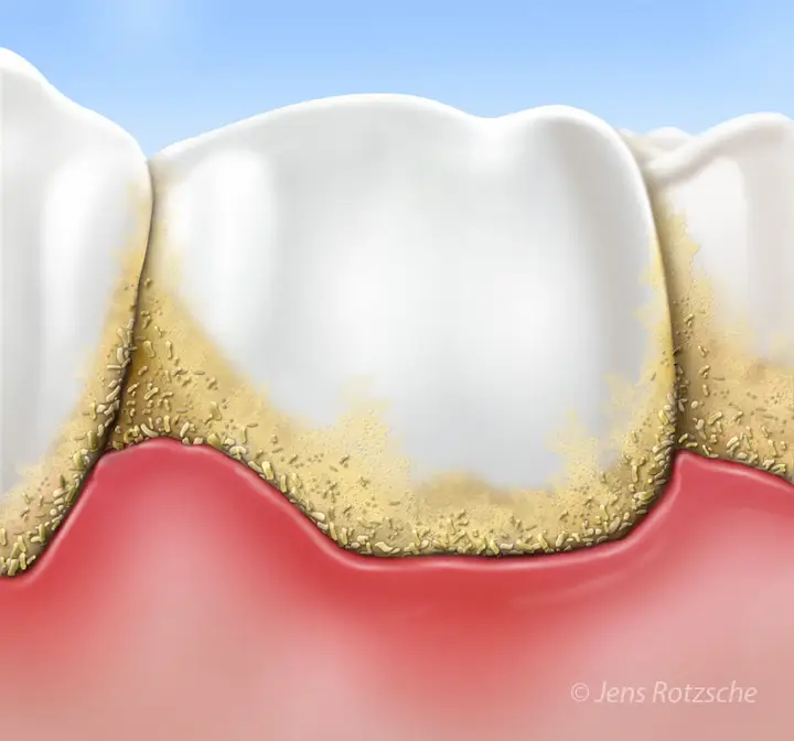 Teeth Periodontitis